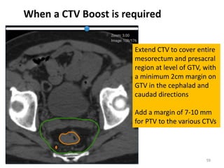 When a CTV Boost is required
59
Extend CTV to cover entire
mesorectum and presacral
region at level of GTV, with
a minimum 2cm margin on
GTV in the cephalad and
caudad directions
Add a margin of 7-10 mm
for PTV to the various CTVs
 