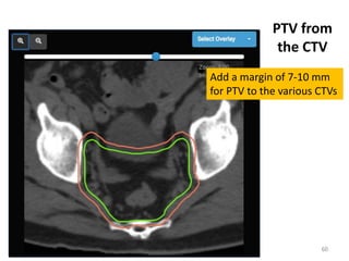 PTV from
the CTV
60
Add a margin of 7-10 mm
for PTV to the various CTVs
 