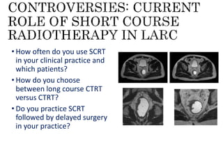 Controversies in the management of rectal cancers | PPTX