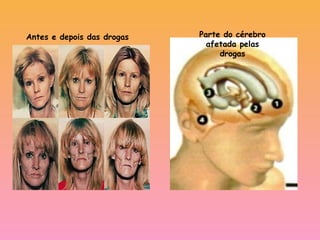 Antes e depois das drogas Parte do cérebro
afetada pelas
drogas
 