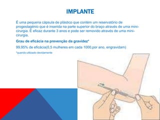 IMPLANTE
É uma pequena cápsula de plástico que contém um reservatório de
progestagénio que é inserida na parte superior do braço através de uma mini-
cirurgia. É eficaz durante 3 anos e pode ser removido através de uma mini-
cirurgia.
Grau de eficácia na prevenção da gravidez*
99,95% de eficácia(0,5 mulheres em cada 1000,por ano, engravidam)
*quando utilizado devidamente
 