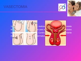 VASECTOMIA Vasectomia é uma operação realizada nos homens que consiste em cortar os canais deferentes para evitar que os espermatozóides se possam unir com o óvulo. Continua-se a ejacular normalmente mas o sémen deixa de ter espermatozóides. 