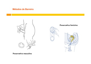 Métodos de Barreira

Preservativo feminino

Preservativo masculino

 