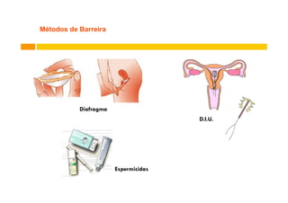 Métodos de Barreira

Diafragma
D.I.U.

Espermicidas

 