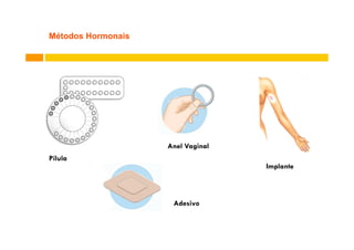 Métodos Hormonais

Anel Vaginal
Pílula

Implante

Adesivo

 