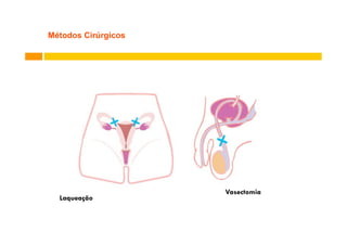 Métodos Cirúrgicos

Laqueação

Vasectomia

 