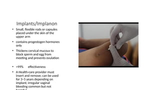 Implants/Implanon
• Small, flexible rods or capsules
placed under the skin of the
upper arm
• contains progestogen hormones
only
• Thickens cervical mucous to
block sperm and egg from
meeting and prevents ovulation
• >99% effectiveness
• A Health-care provider must
insert and remove; can be used
for 3–5 years depending on
implant; irregular vaginal
bleeding common but not
 