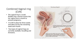 Combined Vaginal ring
(CVR)
• The vaginal ring is a small,
flexible ring a woman inserts into
her vagina once a month to
prevent pregnancy.
• It is left in place for three weeks
and taken out for the remaining
week each month.
• Two types of vaginal rings are
currently available, NuvaRing and
Annovera.
 
