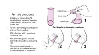 Female condoms
• Sheaths, or linings, that fit
loosely inside a woman's vagina,
made of thin, transparent, soft
plastic film
• Forms a barrier to prevent sperm
and egg from meeting
• 90% effective with correct and
consistent use
• Also protects against sexually
transmitted infections, including
HIV
• Often used together with a
spermicide, should not be used
at the same time as a condom
 