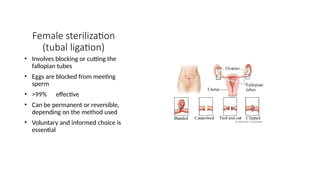 Female sterilization
(tubal ligation)
• Involves blocking or cutting the
fallopian tubes
• Eggs are blocked from meeting
sperm
• >99% effective
• Can be permanent or reversible,
depending on the method used
• Voluntary and informed choice is
essential
 