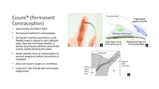 Essure® (Permanent
Contraception)
• Approved by the FDA in 2002
• Permanent method of contraception
• During the insertion procedure, a soft,
flexible insert is placed in each fallopian
tube. Over the next three months, a
barrier (scar tissue) will form around the
inserts, totally blocking the tubes.
• Needs another form of contraception to
prevent pregnancy before the process is
complete .
• Does not require surgery or anesthesia
• Long term risks include pain and ectopic
pregnancies
 
