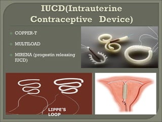 Merine Loop Contraception | PDF