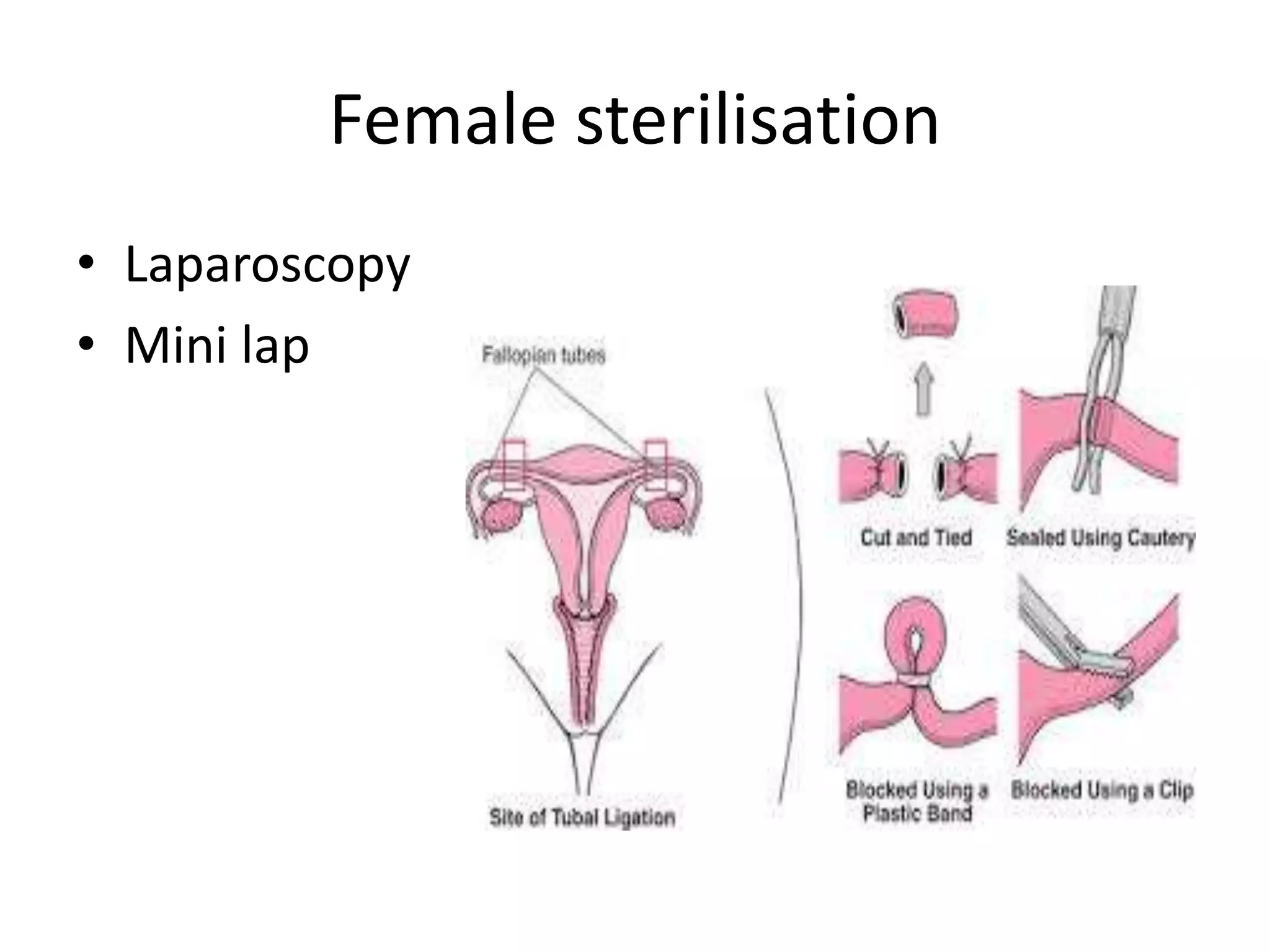 Contraception | PPTX