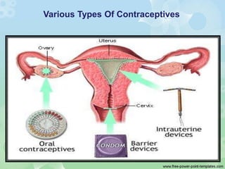 Various Types Of Contraceptives
 