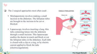  The 2 surgical approaches most often used:
• Minilaparotomy involves making a small
incision in the abdomen. The fallopian tubes
are brought to the incision to be cut or
blocked.
• Laparoscopy involves inserting a long, thin
tube containing lenses into the abdomen
through a small incision. This laparoscope
enables the doctor to reach and block or cut
the fallopian tubes in the abdomen. Each tube
is closed with a clip or a ring, or by electric
current applied to block the tube
(electrocoagulation).
Prof. Rupali Mahadik
 