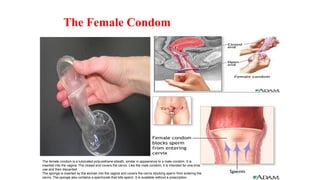 The Female Condom
The female condom is a lubricated polyurethane sheath, similar in appearance to a male condom. It is
inserted into the vagina. The closed end covers the cervix. Like the male condom, it is intended for one-time
use and then discarded.
The sponge is inserted by the woman into the vagina and covers the cervix blocking sperm from entering the
cervix. The sponge also contains a spermicide that kills sperm. It is available without a prescription.
 