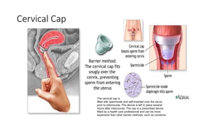 Cervical Cap
The cervical cap is a flexible rubber cup-like device that is
filled with spermicide and self-inserted over the cervix
prior to intercourse. The device is left in place several
hours after intercourse. The cap is a prescribed device
fitted by a health care professional and can be more
expensive than other barrier methods, such as condoms.
 