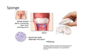 Sponge
The sponge is inserted by the woman into the vagina and covers the
cervix blocking sperm from entering the cervix. The sponge also
contains a spermicide that kills sperm. It is available without a
prescription
 