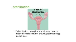 Sterilization
• Tubal ligation - a surgical procedure to close or
block the fallopian tubes ensuring sperm and egg
do not meet
 