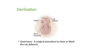 Sterilization
• Vasectomy - A surgical procedure to close or block
the vas deferens
 