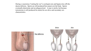 During a vasectomy (“cutting the vas”) a urologist cuts and ligates (ties off) the
ductus deferens. Sperm are still produced but cannot exit the body. Sperm
eventually deteriorate and are phagocytized. A man is sterile, but because
testosterone is still produced he retains his sex drive and secondary sex
characteristics.
 