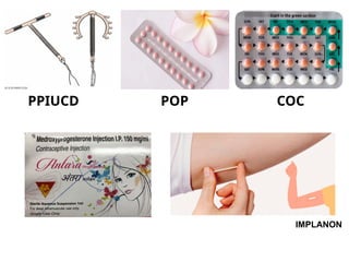 IMPLANON
PPIUCD POP COC
 