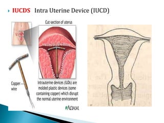  IUCDS Intra Uterine Device (IUCD)
 