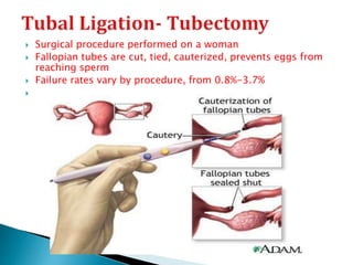  Surgical procedure performed on a woman
 Fallopian tubes are cut, tied, cauterized, prevents eggs from
reaching sperm
 Failure rates vary by procedure, from 0.8%-3.7%

 