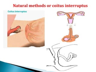 Natural methods or coitus interruptus
 