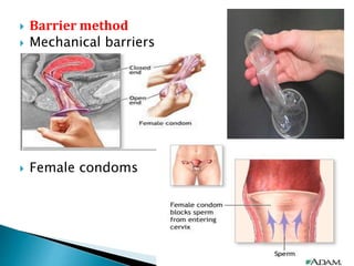  Barrier method
 Mechanical barriers
 Female condoms
 