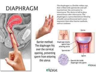 The diaphragm is a flexible rubber cup
that is filled with spermicide and self-
inserted over the cervix prior to
intercourse. The device is left in place
several hours after intercourse. The
diaphragm is a prescribed device fitted by
a health care professional and is more
expensive than other barrier methods,
such as condoms
 