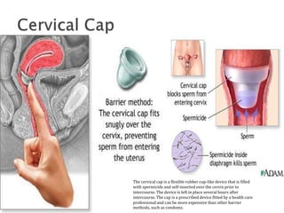 The cervical cap is a flexible rubber cup-like device that is filled
with spermicide and self-inserted over the cervix prior to
intercourse. The device is left in place several hours after
intercourse. The cap is a prescribed device fitted by a health care
professional and can be more expensive than other barrier
methods, such as condoms.
 
