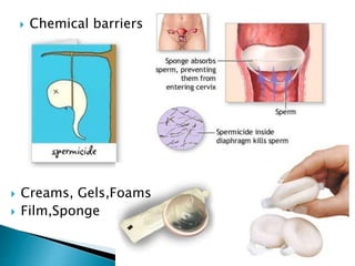  Chemical barriers
 Creams, Gels,Foams
 Film,Sponge
 