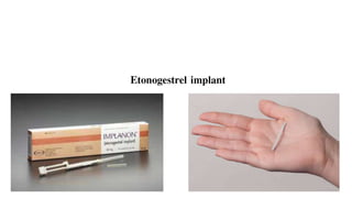 Etonogestrel implant
 