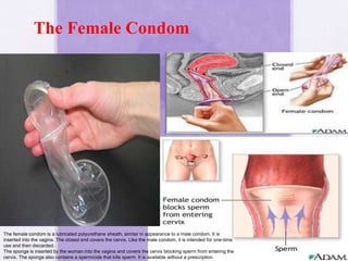 The Female Condom
The female condom is a lubricated polyurethane sheath, similar in appearance to a male condom. It is
inserted into the vagina. The closed end covers the cervix. Like the male condom, it is intended for one-time
use and then discarded.
The sponge is inserted by the woman into the vagina and covers the cervix blocking sperm from entering the
cervix. The sponge also contains a spermicide that kills sperm. It is available without a prescription.
 