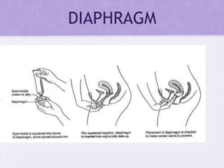DIAPHRAGM
 