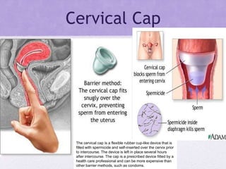Cervical Cap
The cervical cap is a flexible rubber cup-like device that is
filled with spermicide and self-inserted over the cervix prior
to intercourse. The device is left in place several hours
after intercourse. The cap is a prescribed device fitted by a
health care professional and can be more expensive than
other barrier methods, such as condoms.
 