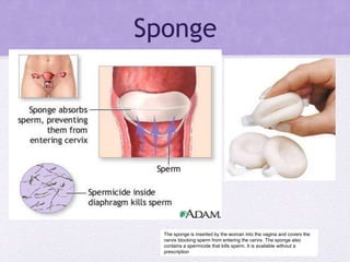 Sponge
The sponge is inserted by the woman into the vagina and covers the
cervix blocking sperm from entering the cervix. The sponge also
contains a spermicide that kills sperm. It is available without a
prescription
 