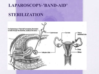 LAPAROSCOPY-’BAND-AID’
STERILIZATION
 