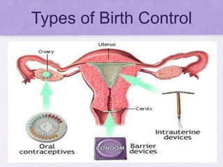 Types of Birth Control
 
