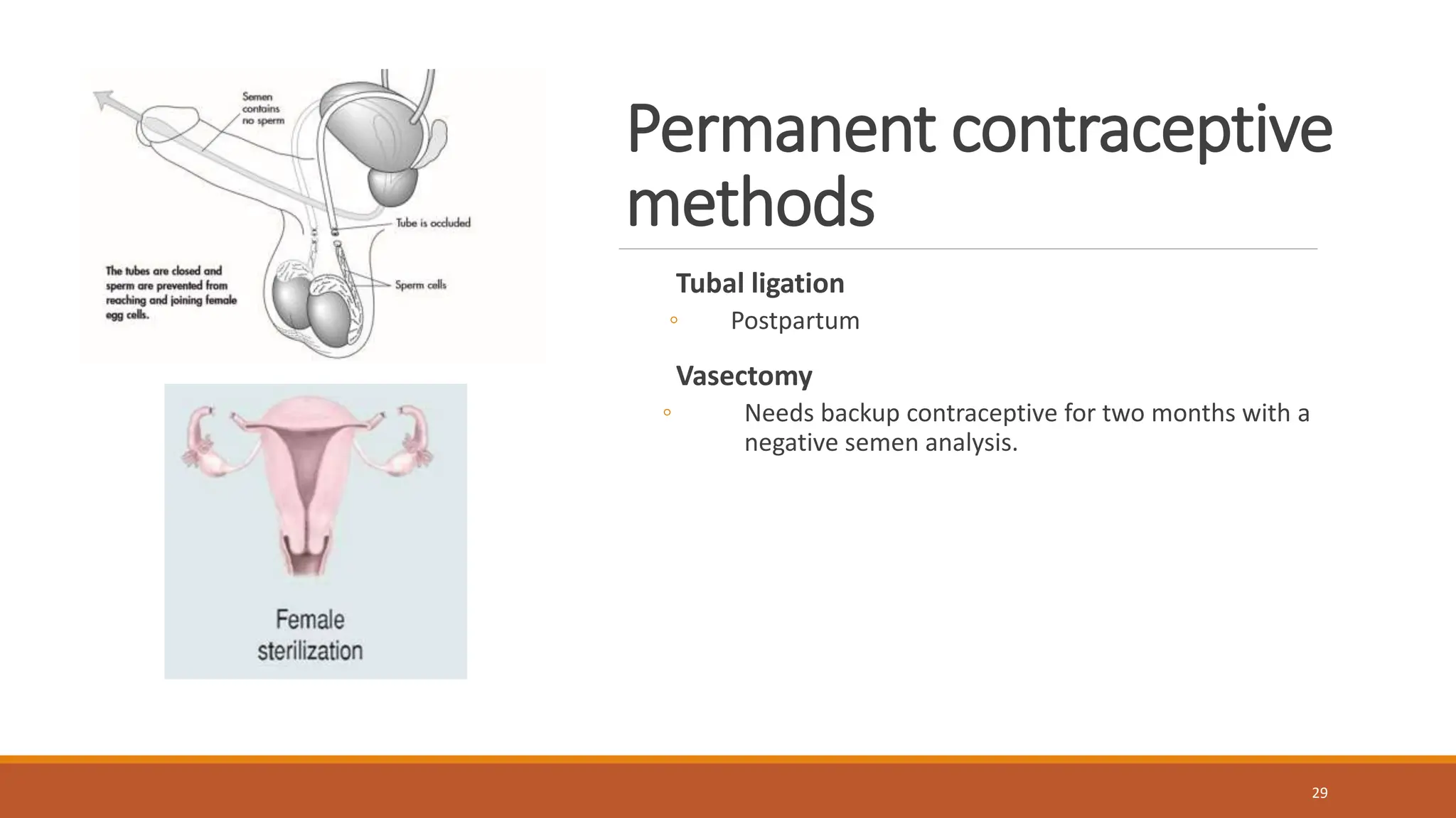 Permanent contraceptive
methods
Tubal ligation
◦ Postpartum
Vasectomy
◦ Needs backup contraceptive for two months with a
negative semen analysis.
29
 