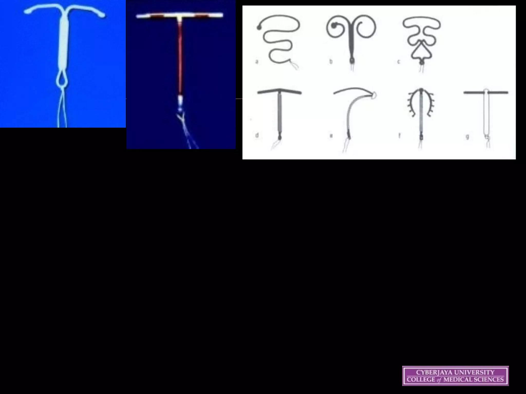 INTRAUTERINE DEVICES
 