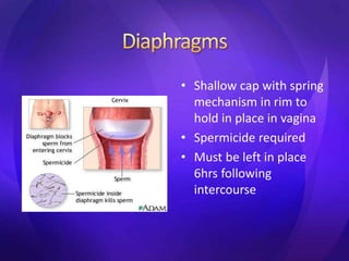 • Shallow cap with spring
mechanism in rim to
hold in place in vagina
• Spermicide required
• Must be left in place
6hrs following
intercourse
 