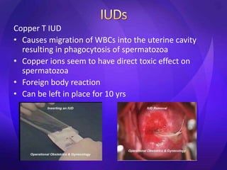 Copper T IUD
• Causes migration of WBCs into the uterine cavity
resulting in phagocytosis of spermatozoa
• Copper ions seem to have direct toxic effect on
spermatozoa
• Foreign body reaction
• Can be left in place for 10 yrs
 