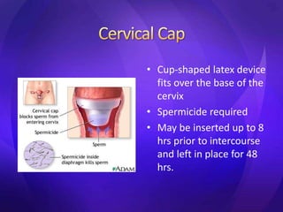 • Cup-shaped latex device
fits over the base of the
cervix
• Spermicide required
• May be inserted up to 8
hrs prior to intercourse
and left in place for 48
hrs.
 