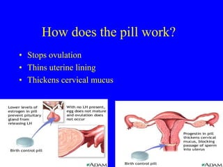 How does the pill work? 
• Stops ovulation 
• Thins uterine lining 
• Thickens cervical mucus 
 