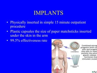 IMPLANTS 
• Physically inserted in simple 15 minute outpatient 
procedure 
• Plastic capsules the size of paper matchsticks inserted 
under the skin in the arm 
• 99.5% effectiveness rate 
 