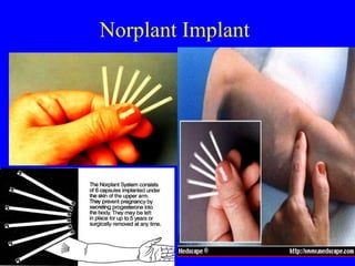 Norplant Implant 
 