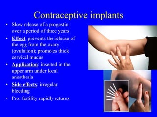 Contraceptive implants 
• Slow release of a progestin 
over a period of three years 
• Effect: prevents the release of 
the egg from the ovary 
(ovulation); promotes thick 
cervical mucus 
• Application: inserted in the 
upper arm under local 
anesthesia 
• Side effects: irregular 
bleeding 
• Pro: fertility rapidly returns 
 