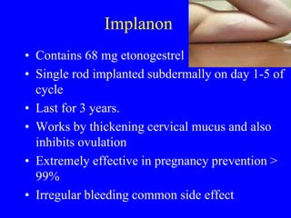 Implanon 
• Contains 68 mg etonogestrel 
• Single rod implanted subdermally on day 1-5 of 
cycle 
• Last for 3 years. 
• Works by thickening cervical mucus and also 
inhibits ovulation 
• Extremely effective in pregnancy prevention > 
99% 
• Irregular bleeding common side effect 
 